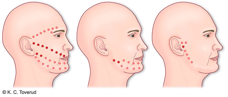 Referred pain from trigger points in the M. masseter.